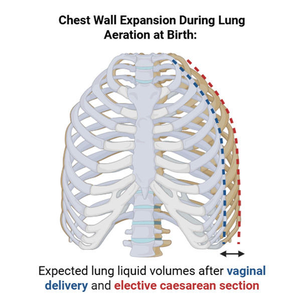 The chest wall is more expanded in newborns with expected lung liquid volumes after caesarean section (increased pulmonary oedema; red dashed line) than vaginal delivery (blue dashed line).